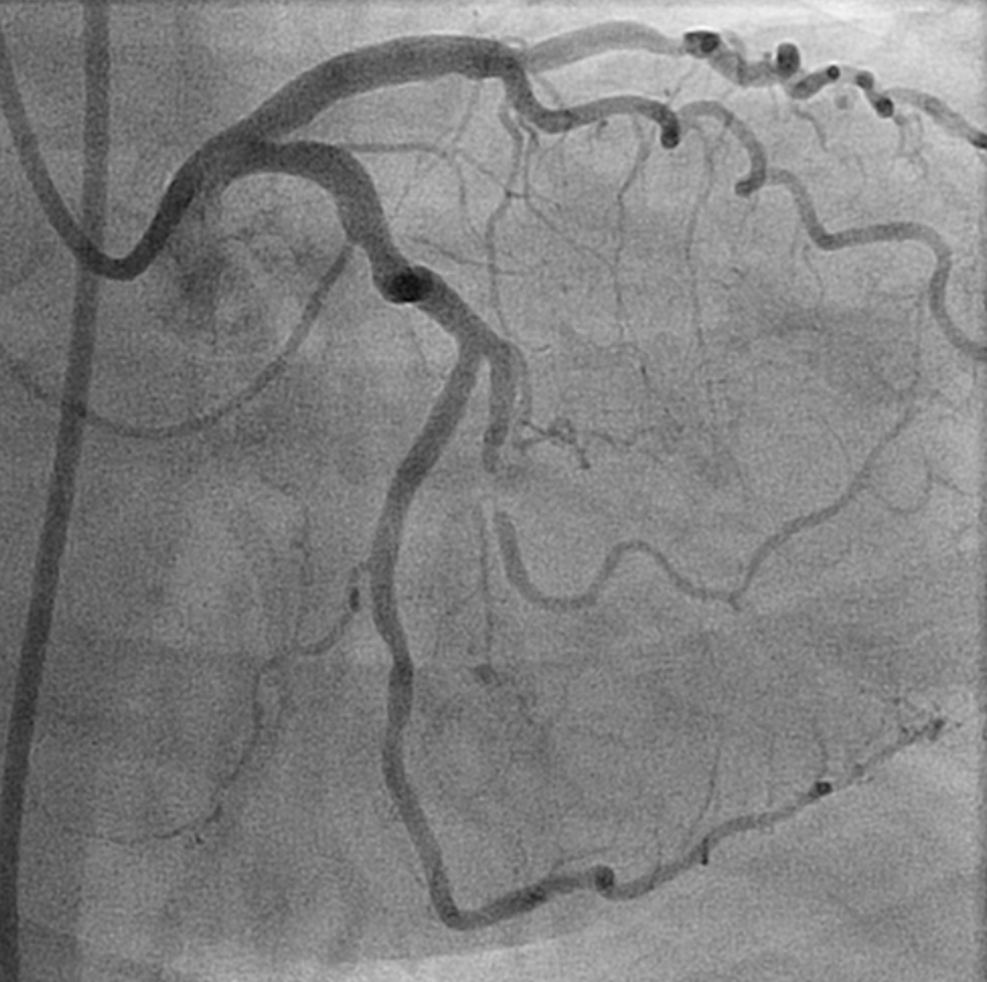 Edge Dissection Post Stent Deployment? - American College Of Cardiology